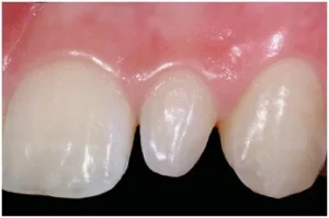 What Are Peg Teeth And How Do I Fix Them